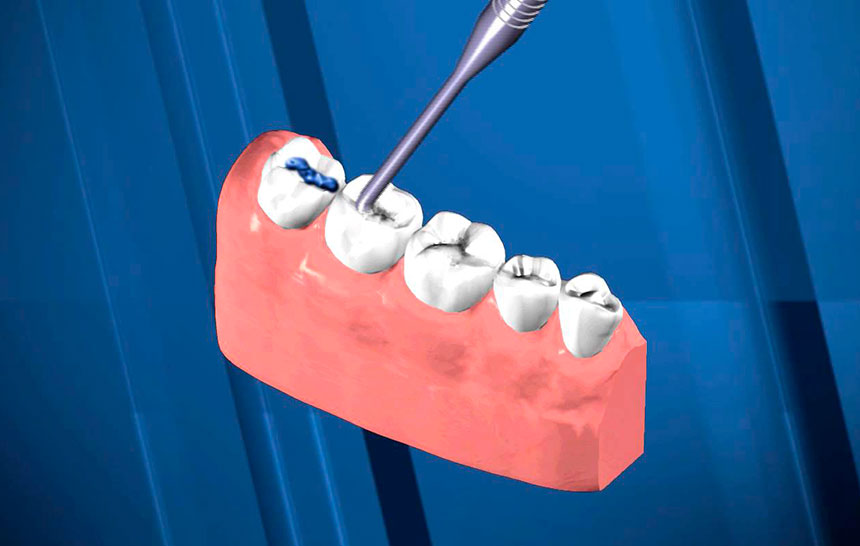 ¿Qué son y para qué sirven los sellantes dentales?